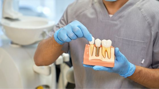 4 Benefits of Receiving a Full Arch of Dental Implants