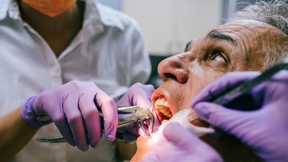 Tooth Extraction - A Complete Guide